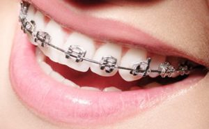 Mini-implante Dentário